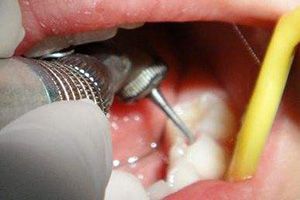 Does Dental Filling Affect Implant Success To Chinese Mainland
