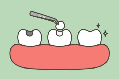 How to Assess Your Dental Health Before Getting Fillings in Chinese Mainland