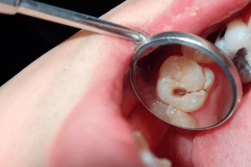 Is Dental Work in Chinese Mainland Attractive for Those on a Budget