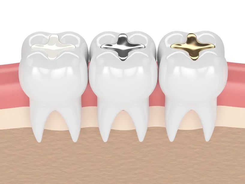 How Long Does a Tooth Filling Take in Chinese Mainland