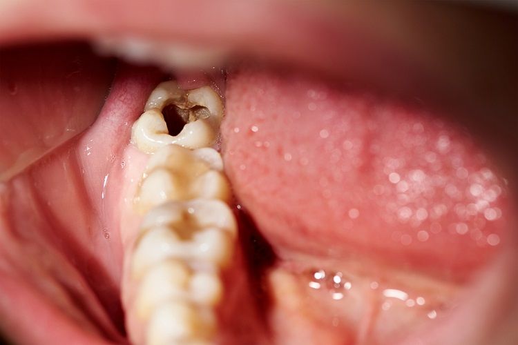 Are There Hidden Fees for Dental Fillings in Chinese Mainland
