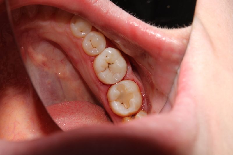Common Misconceptions About Dental Fillings To Chinese Mainland