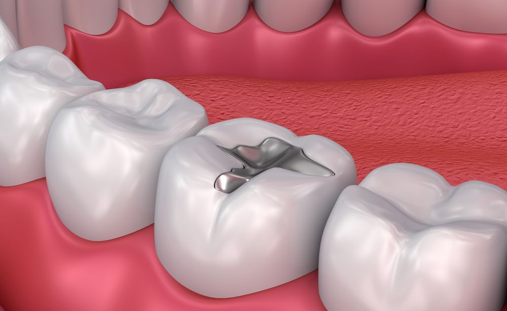 What to Expect When Getting Dental Fillings in the Chinese Mainland