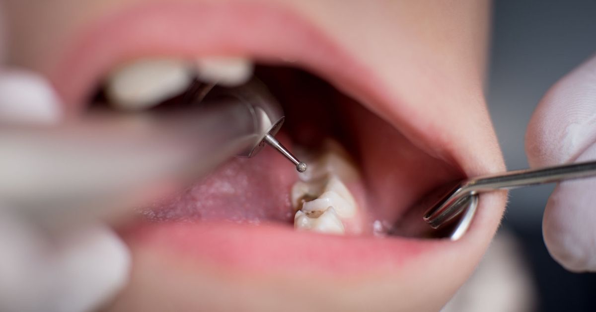 Why More Hong Kong Residents Choose To Chinese Mainland for Dental Fillings
