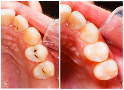 What to Bring for Dental Fillings To Chinese Mainland