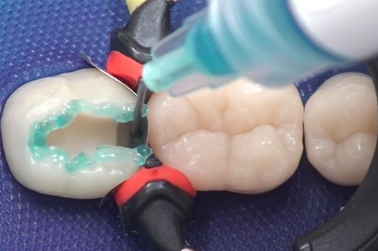 To Chinese Mainland for Quick Dental Fillings Morning Appointment, Afternoon Completion