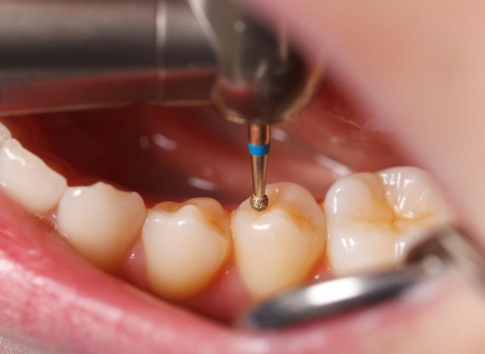 Can You Wear Makeup When Getting Dental Fillings in Chinese Mainland