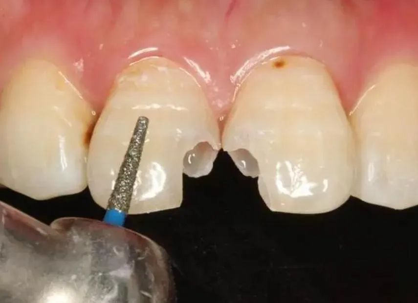 What to Consider When Getting Dental Fillings in Chinese Mainland