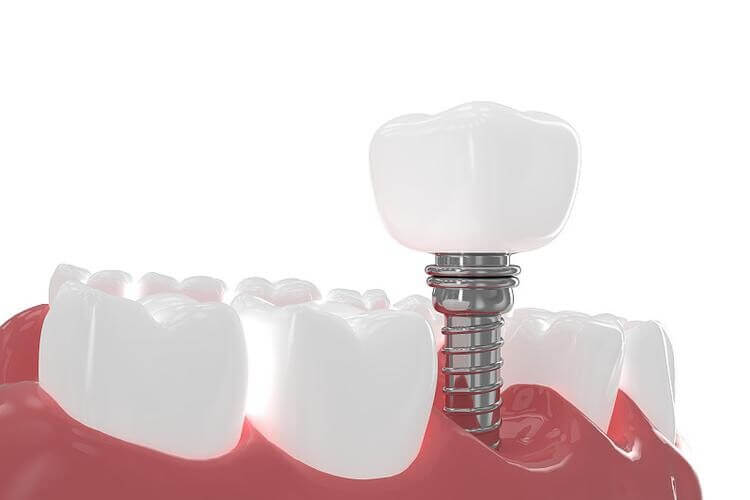 Can I Go Back to Work and Talk All Day Right After Getting a Dental Implant in Beijing