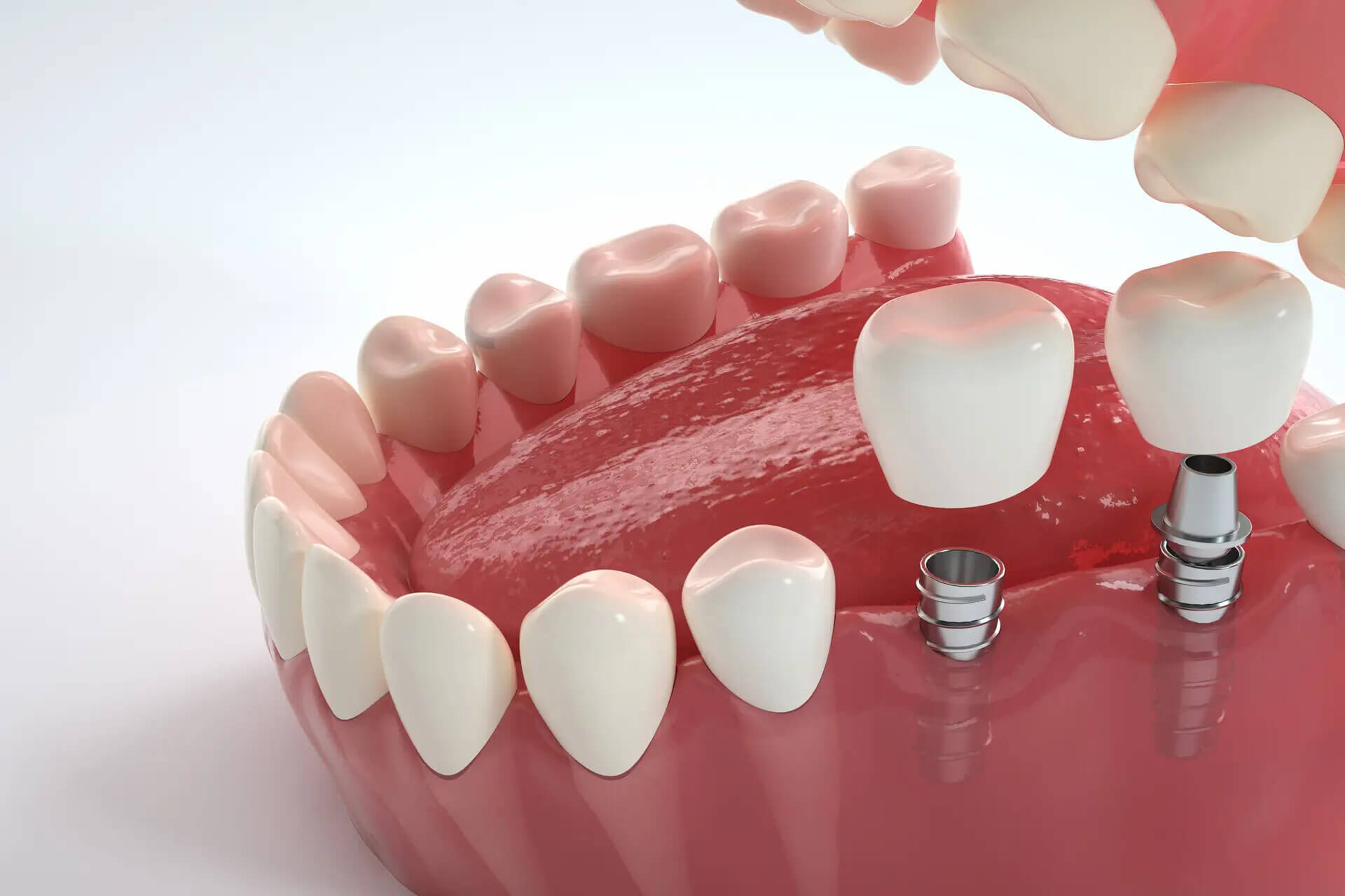 Should I Take Bite Photos Before Getting Dental Implants in the North