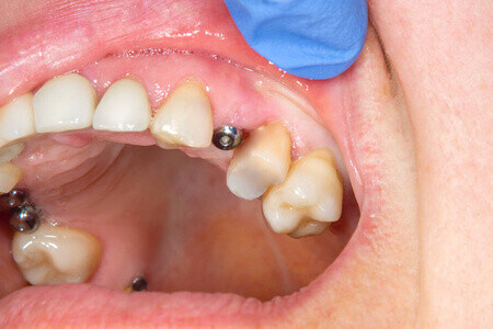 After getting dental implants up north, are you often finding that talking feels uncomfortable or the positioning of your mouth doesnt feel right