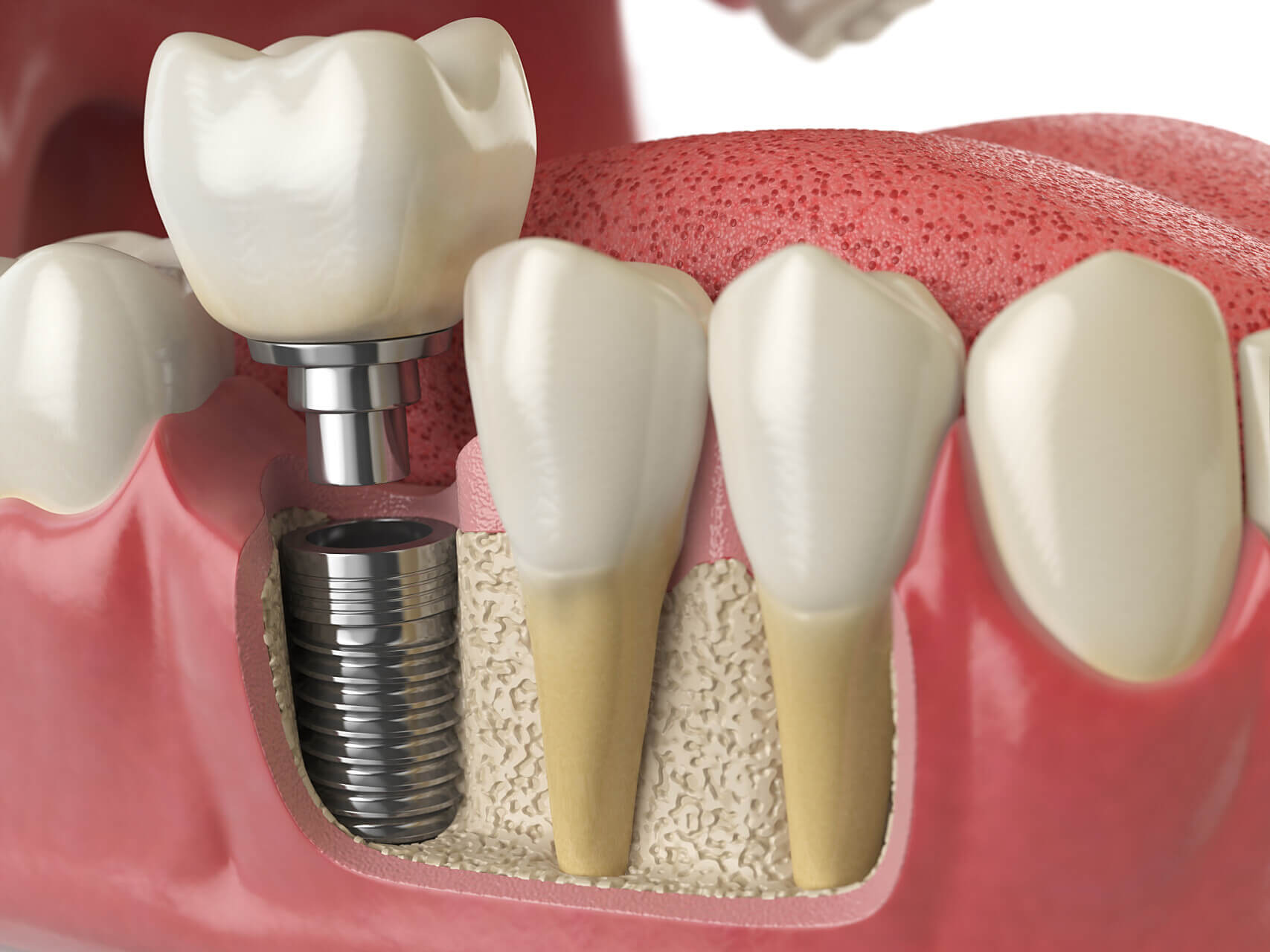 Do I Need to be Hospitalized for Full Mouth Dental Implants in Beijing