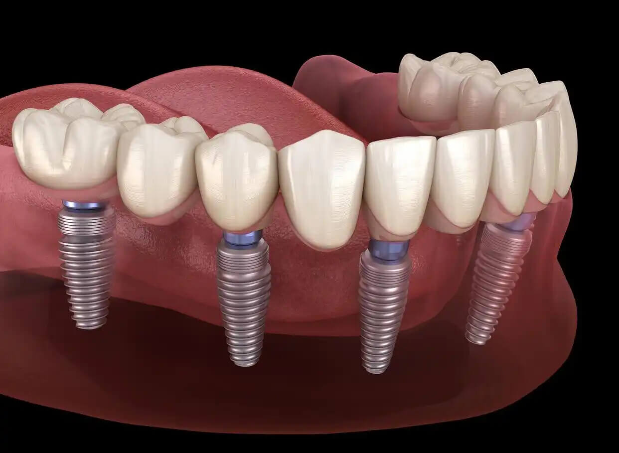 Is it inflammation if you feel root pain while yawning after getting a dental implant in Beijing