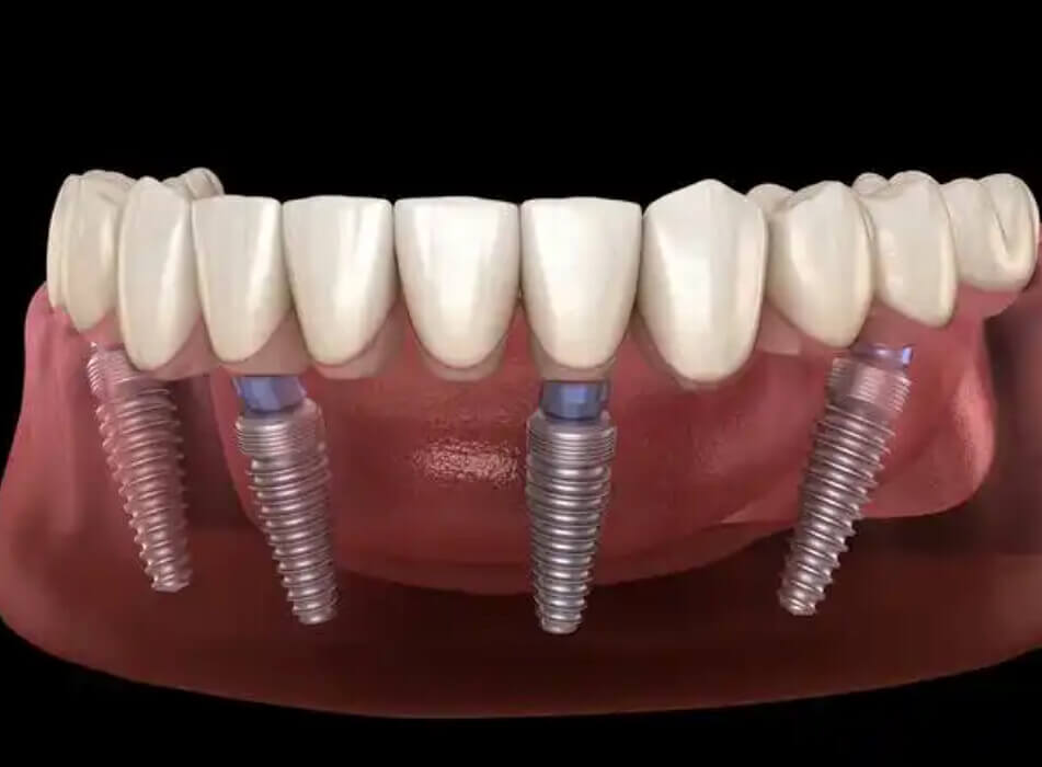 Why Do I Feel the Urge to Bite Constantly After Getting Dental Implants in the North