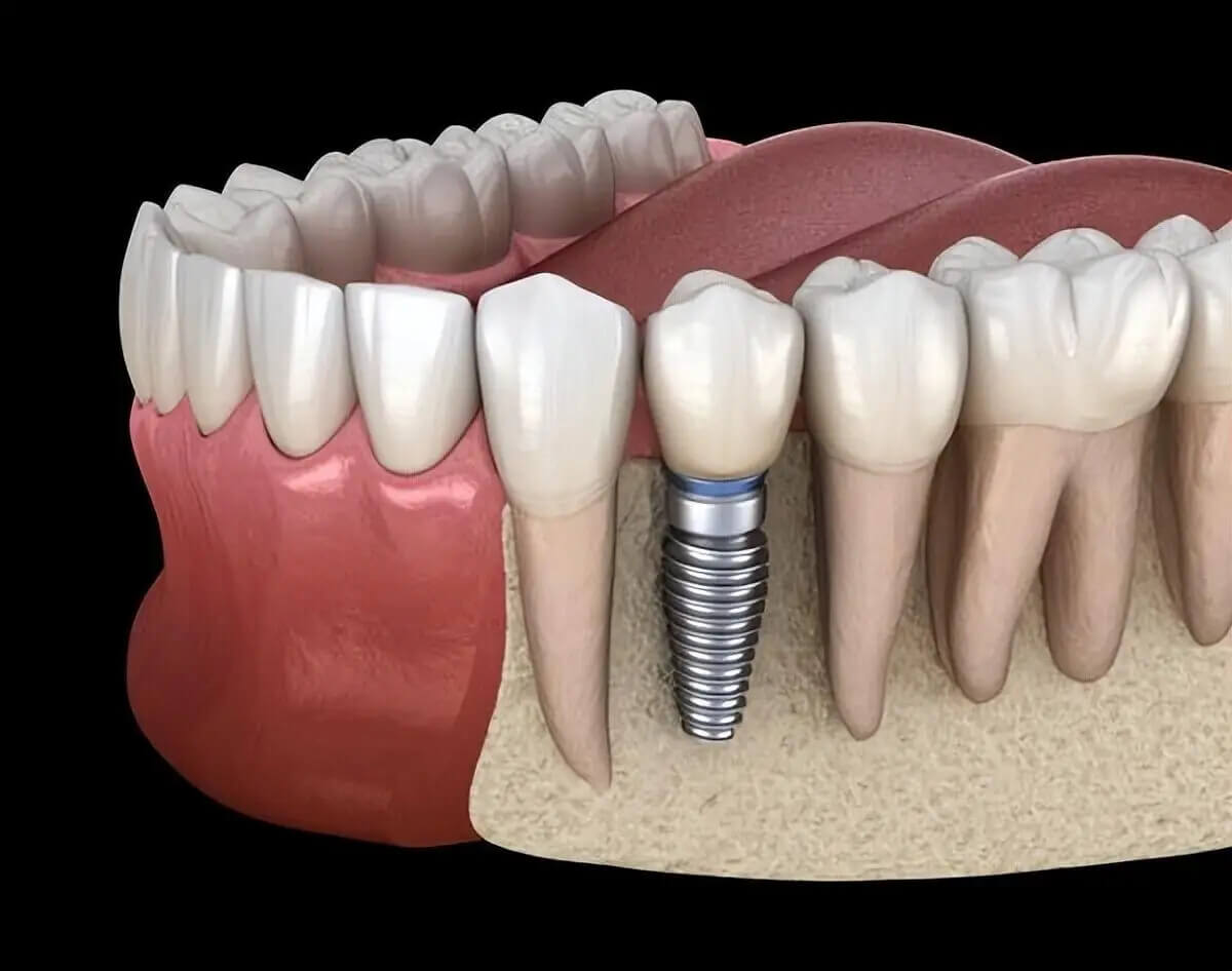 After getting dental implants in the northern area, will the numbness and pain in the root of the tooth go away