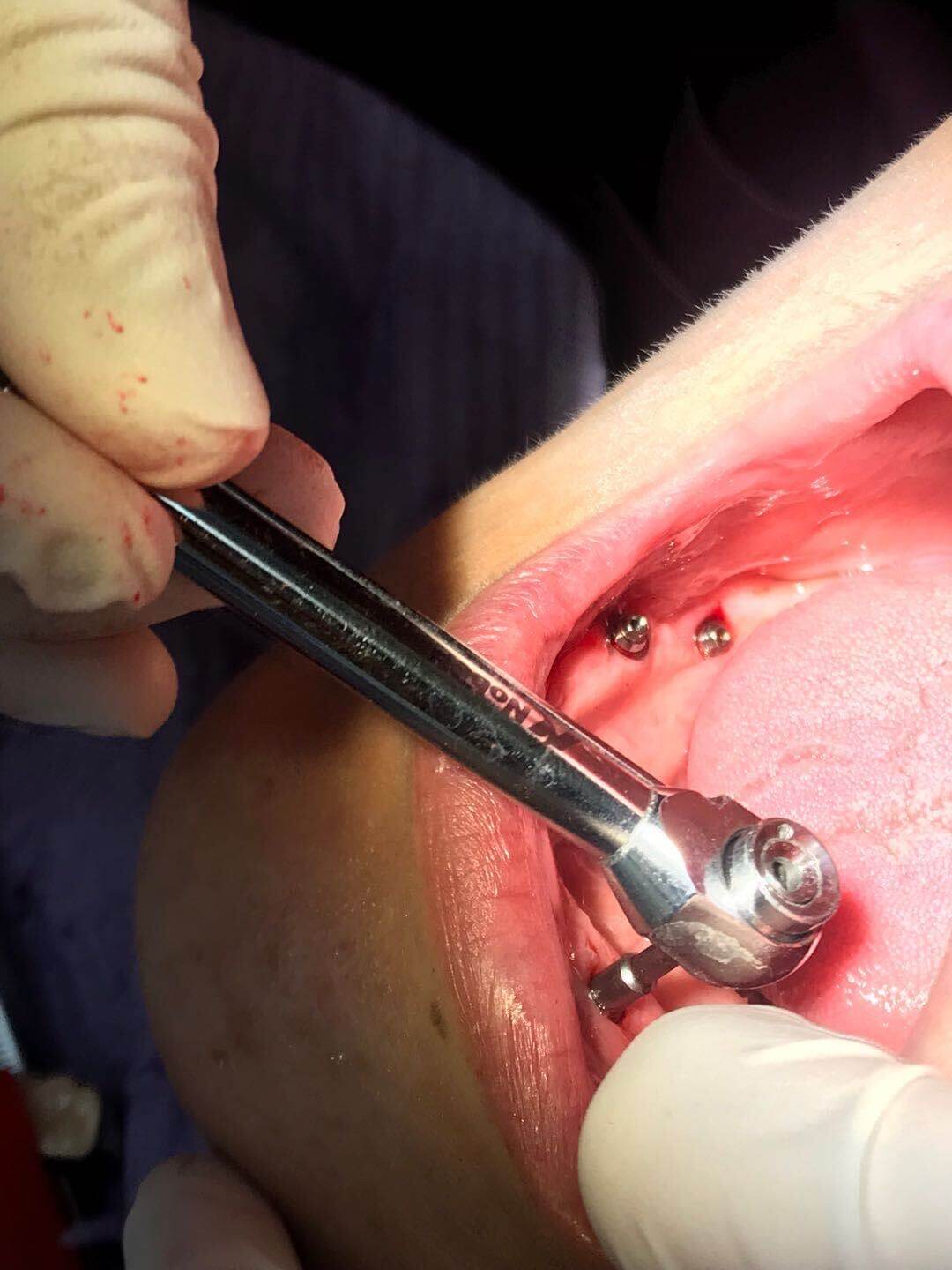 After getting a dental implant in the north, will a crown that looks odd become more comfortable with use over time