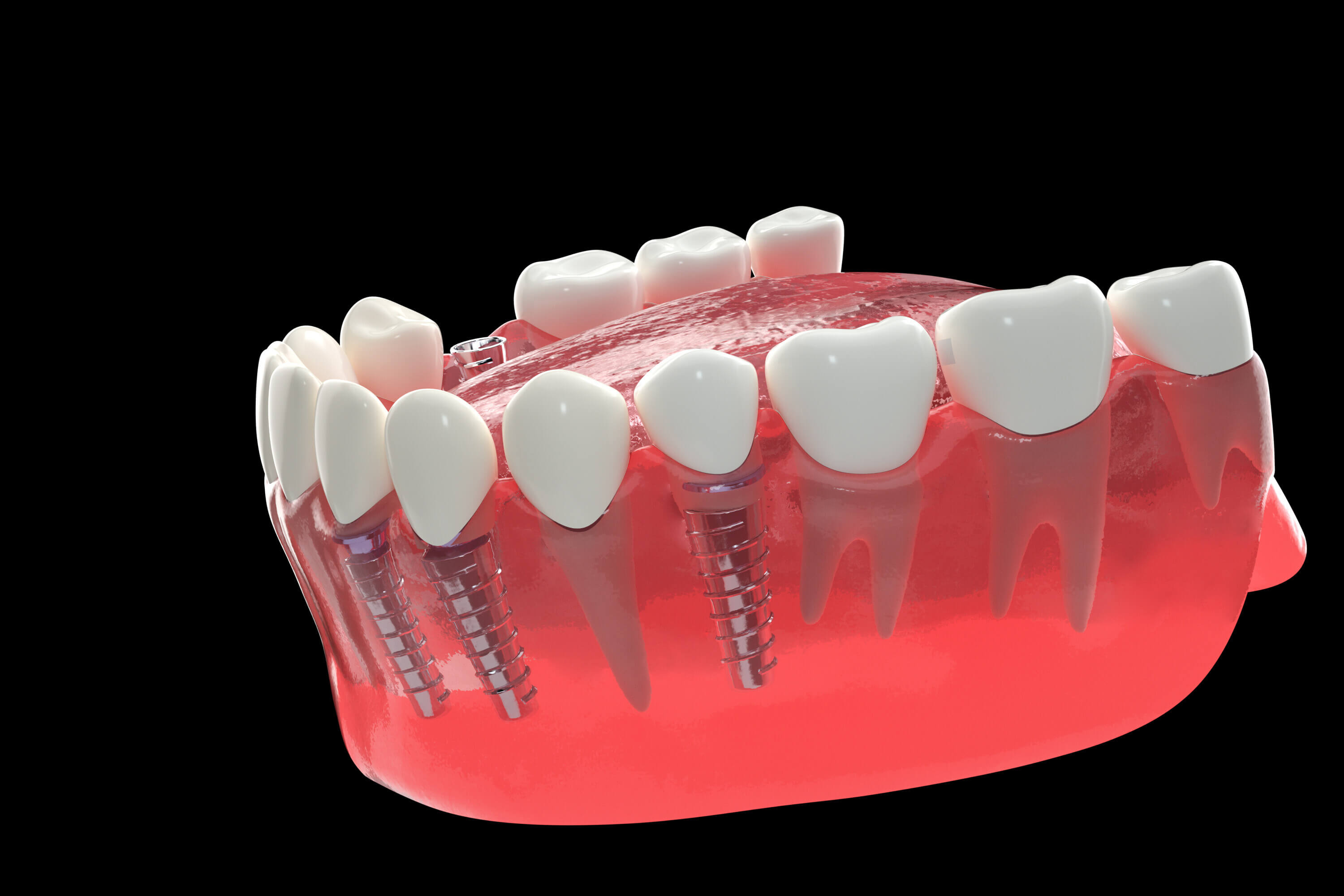 Does Smoking Before Getting Dental Implants Affect Results in Beijing