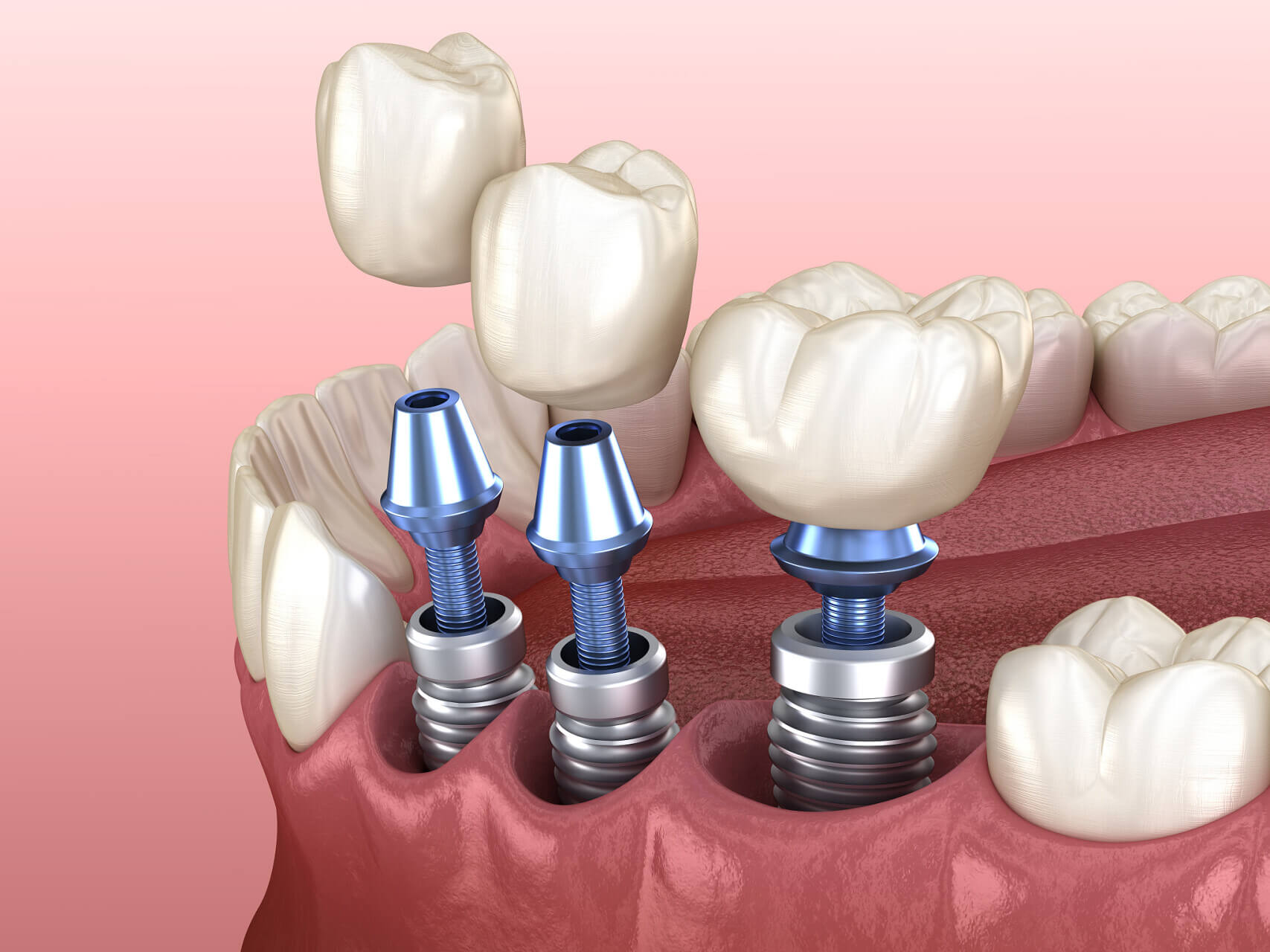 Can I Eat Fried Chicken After Getting Dental Implants Up North