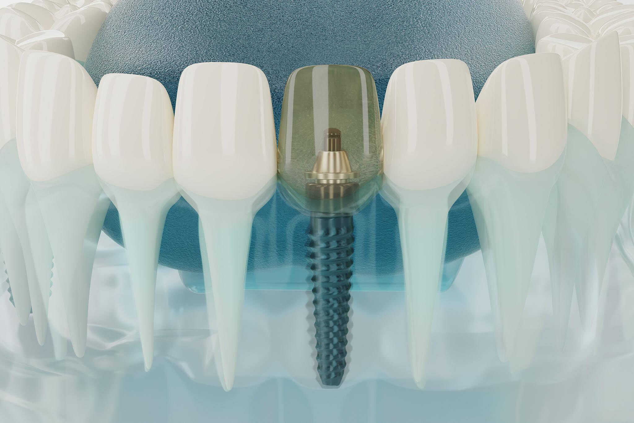 After getting dental implants, do you feel that your teeth have uneven lengths or occlusion issues