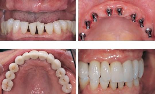 After getting a dental implant in the North, do you feel that the crown is unnaturally heavy and hasnt fully integrated