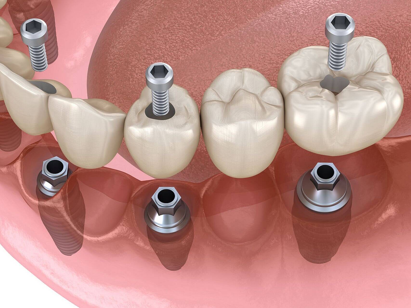 After getting a dental implant in your upper jaw, how long does it take for your gums to heal and return to normal