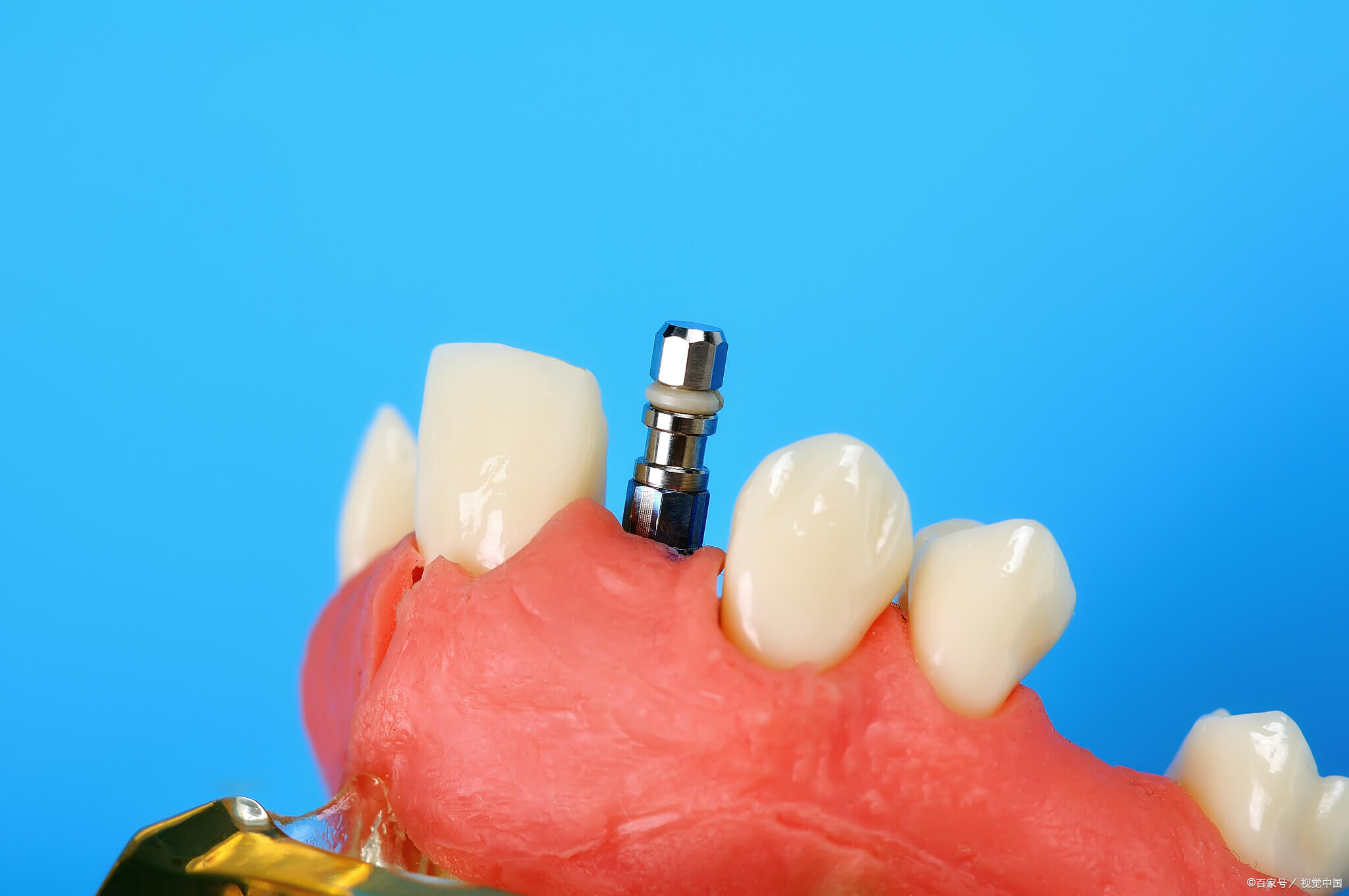 Is It Okay to Eat Soft Foods Like Bread After Dental Implant Surgery in Northern Cities
