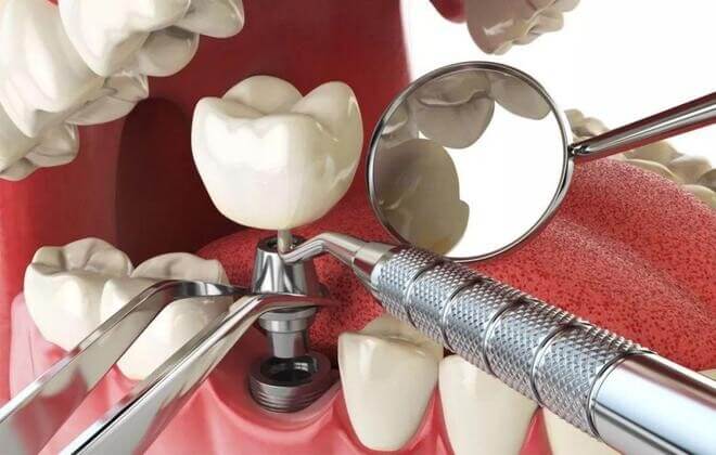 Is it normal to feel slight numbness after dental implants in Beijing or Shanghai