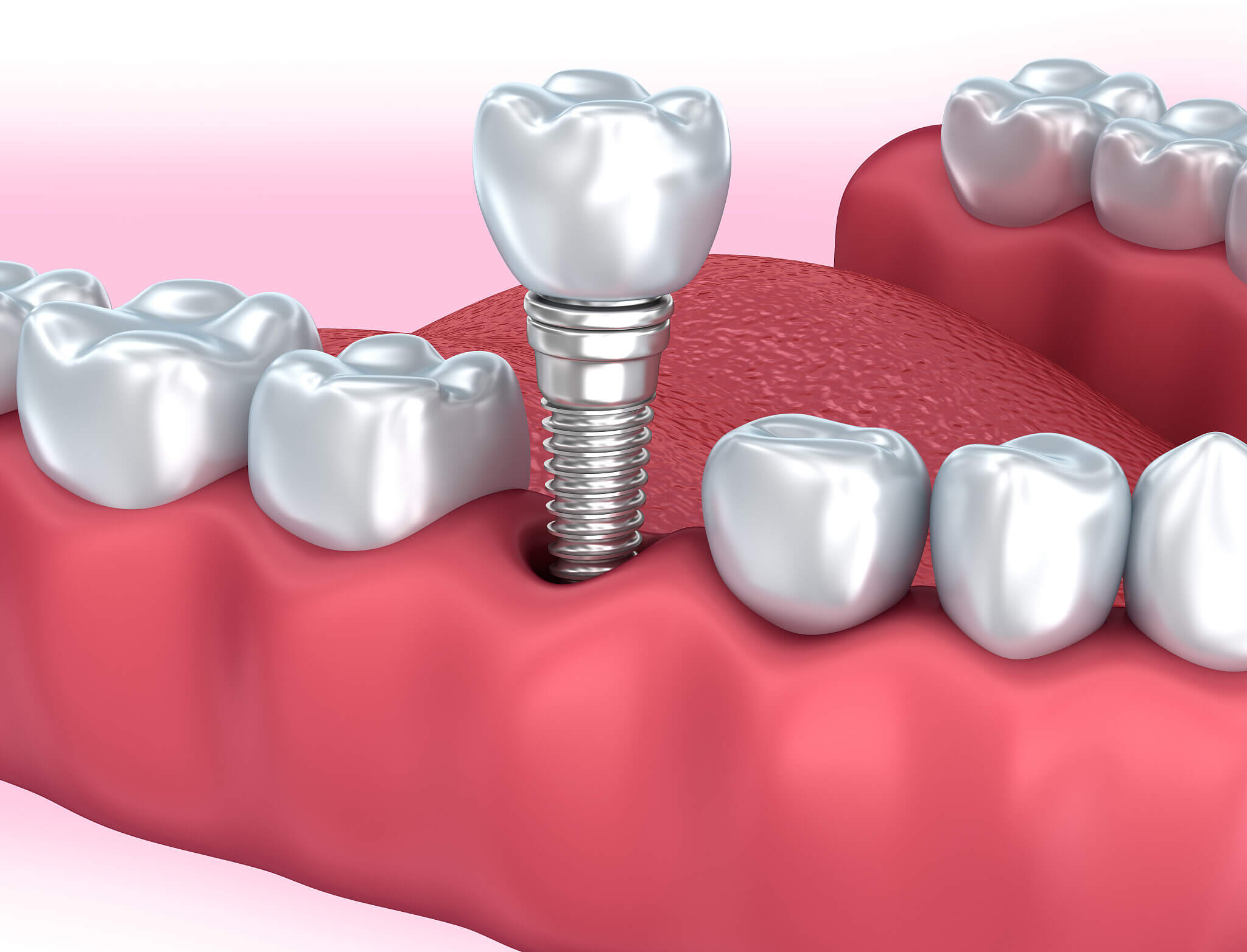 After getting dental implants in the north, is the slight loosening of the crown due to the screws not being tightened