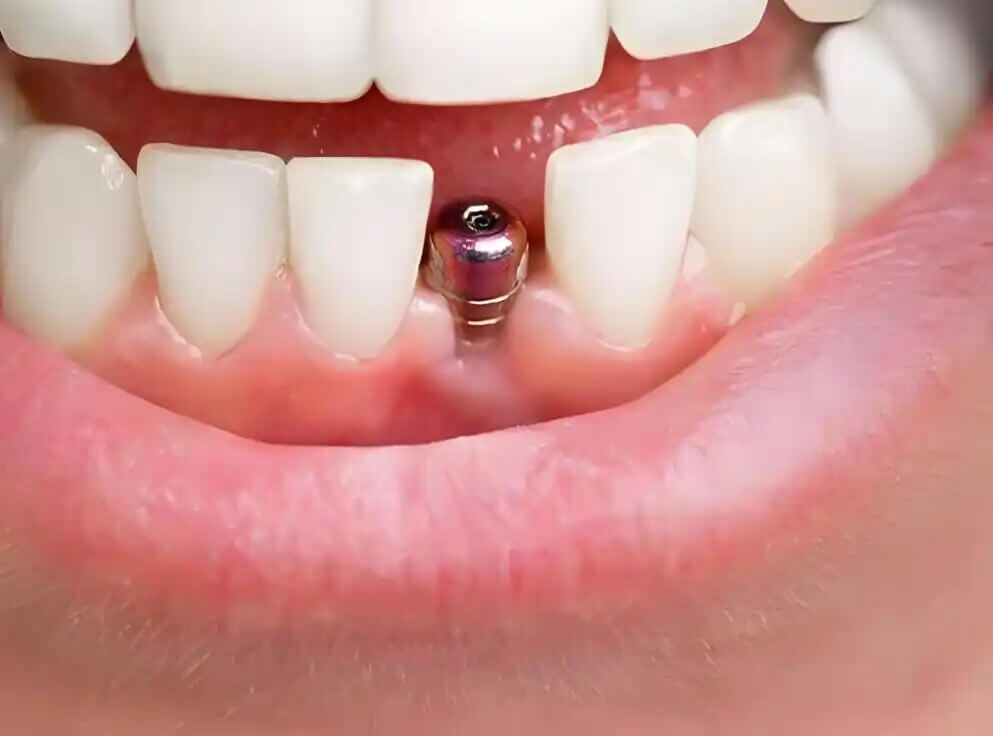 After getting dental implants in the north, do your teeth seem to be growing while your gums are receding