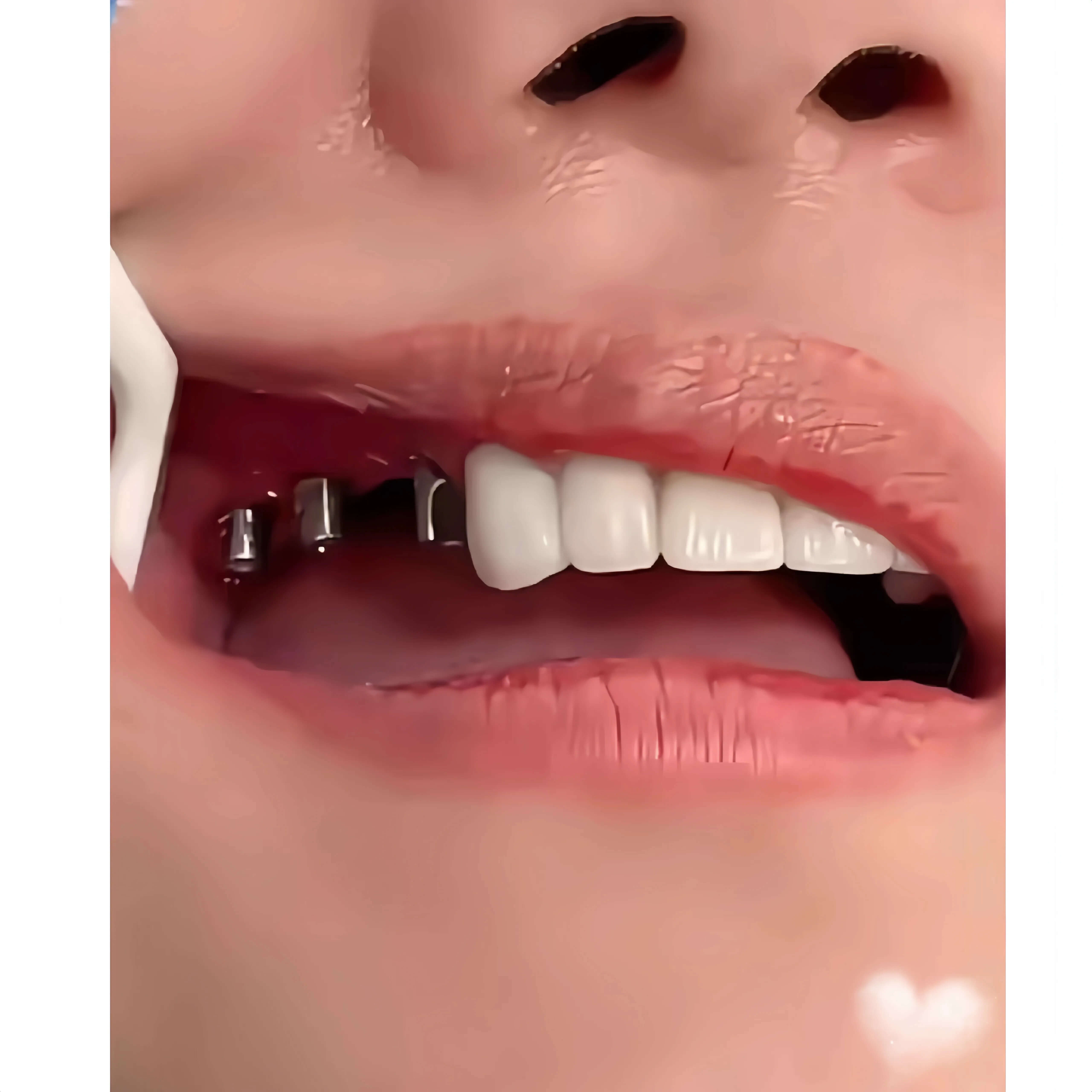 Did you experience swelling at the dental implant site after waking up at night post-implant surgery