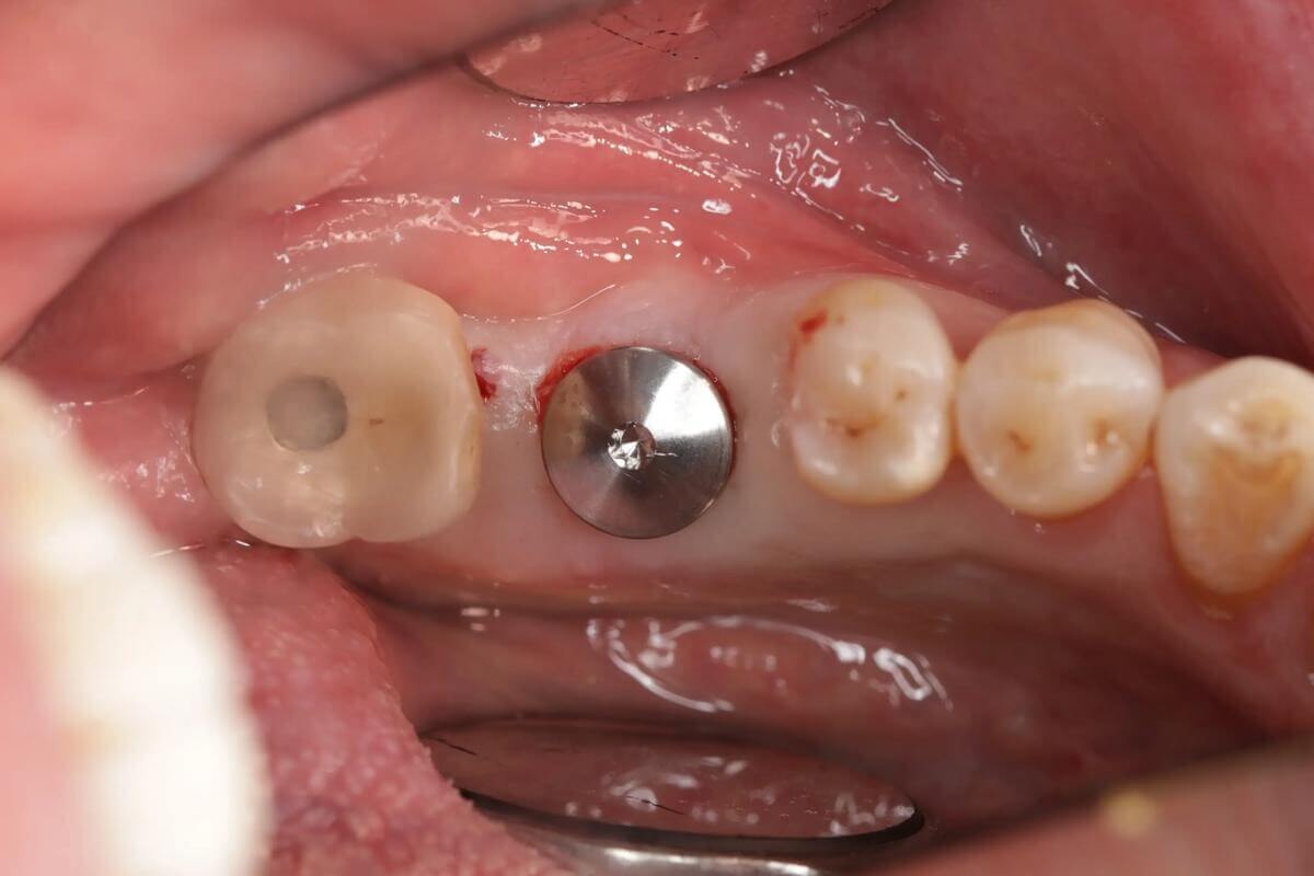 Is There a Sound from Your Dental Crown After Getting an Implant in the North Is It Loose
