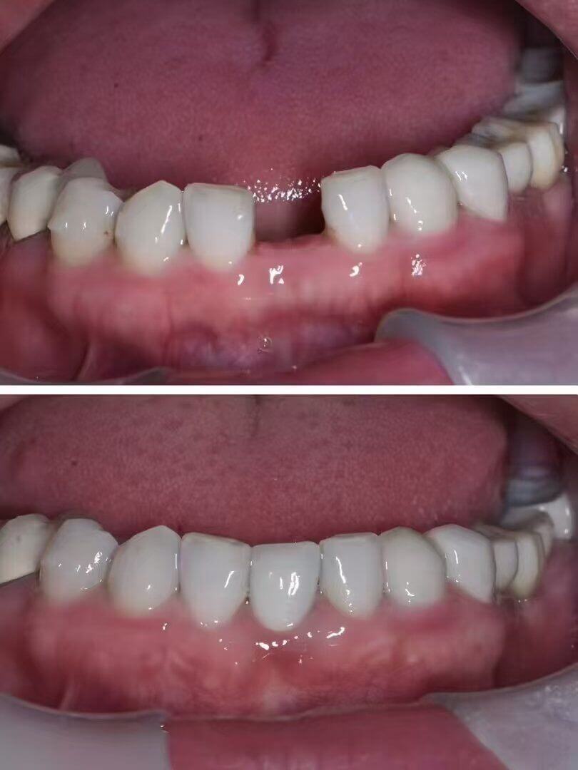 Is it normal to feel airflow between the teeth after getting implants up north