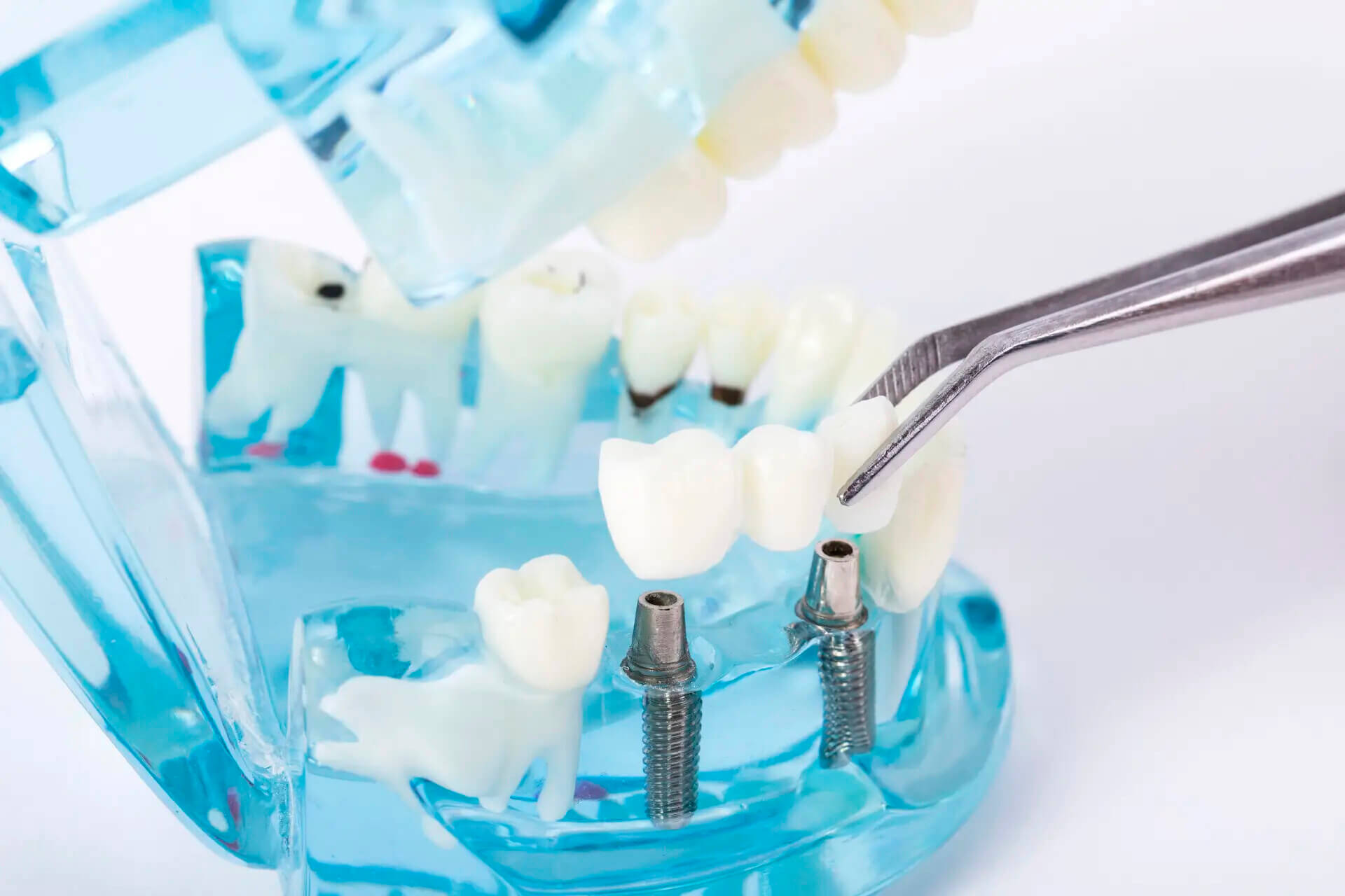 What Happens if the Crown Height is Incorrect After Getting Dental Implants in the Mainland
