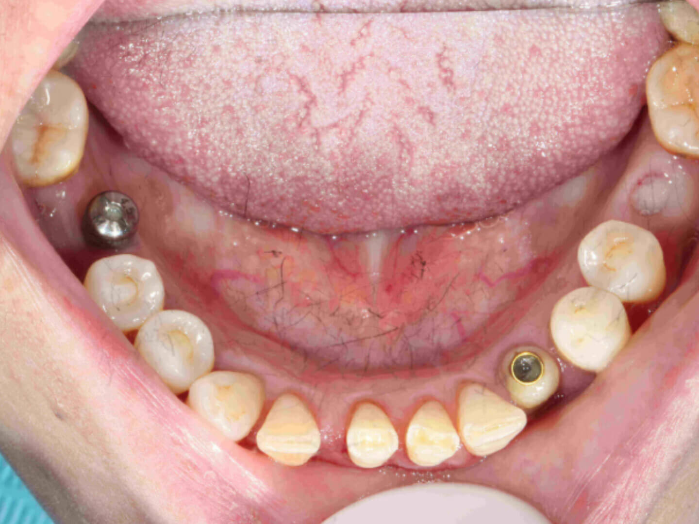 If youve gone to the north for dental implants and find biting into soft foods feels strange, is it just a matter of adjusting