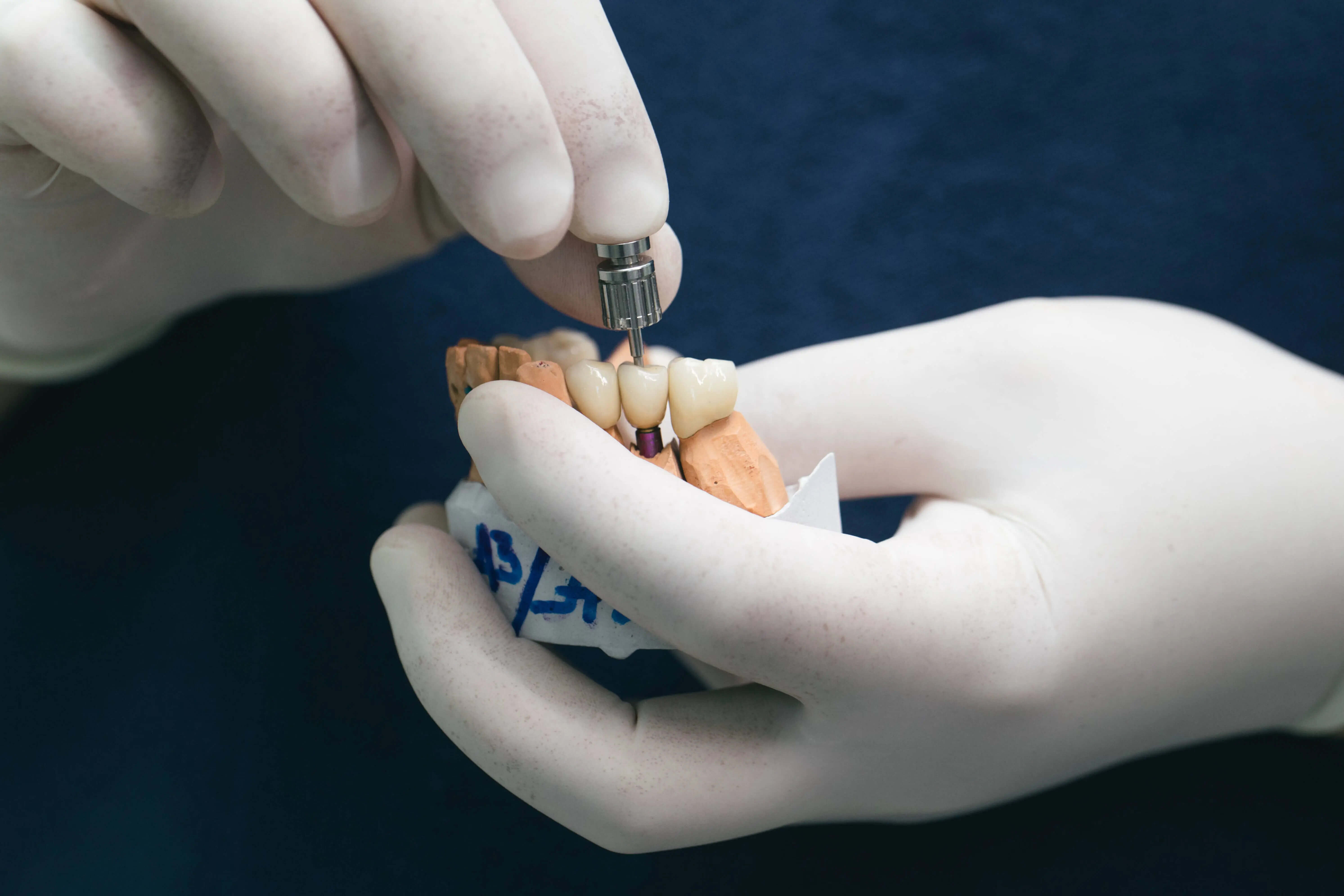 Why Do Dental Crowns Feel Different Every Day After Getting an Implant in the North