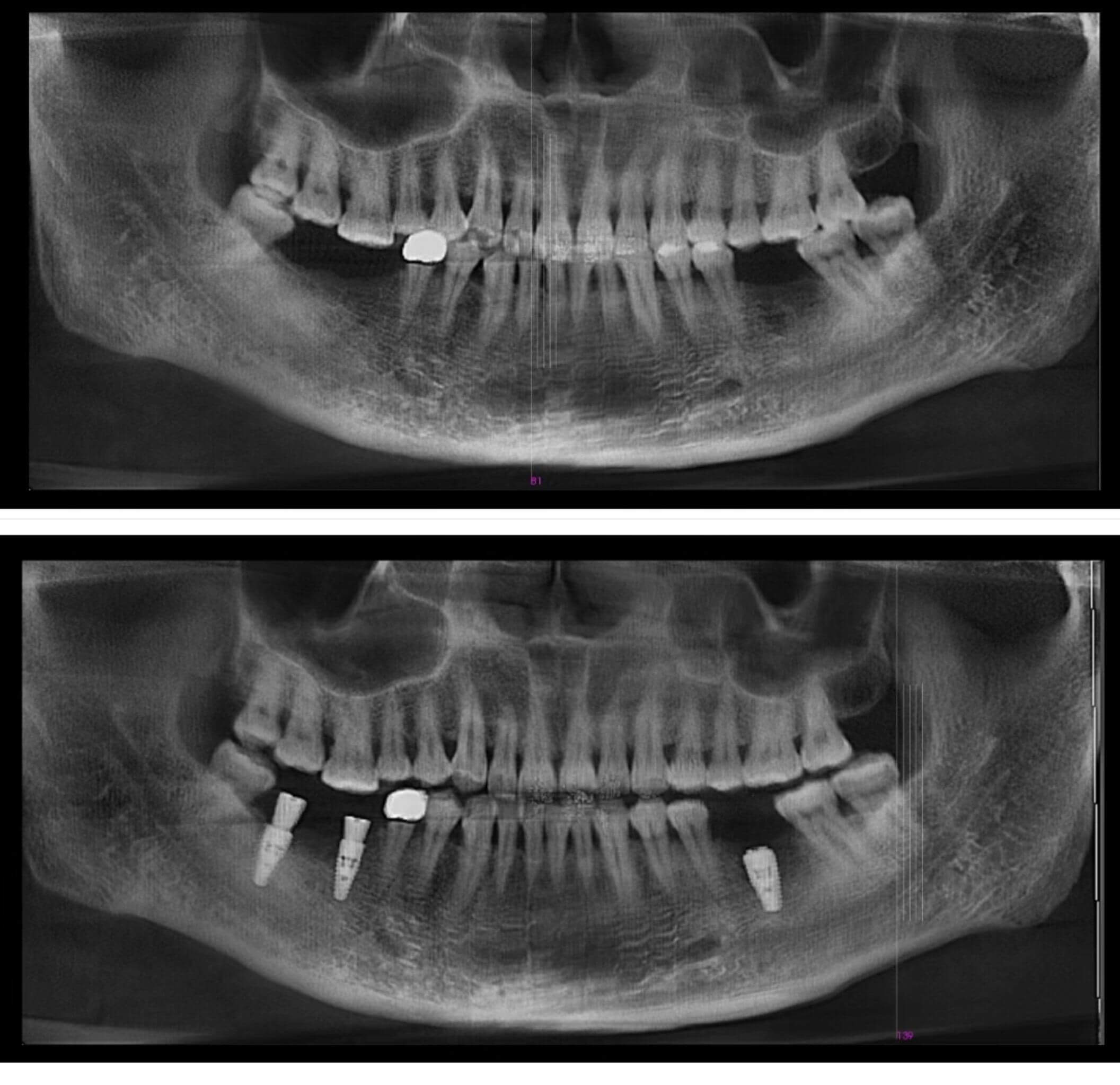Is It Normal for Gums to Turn White After a Dental Implant Procedure in the North
