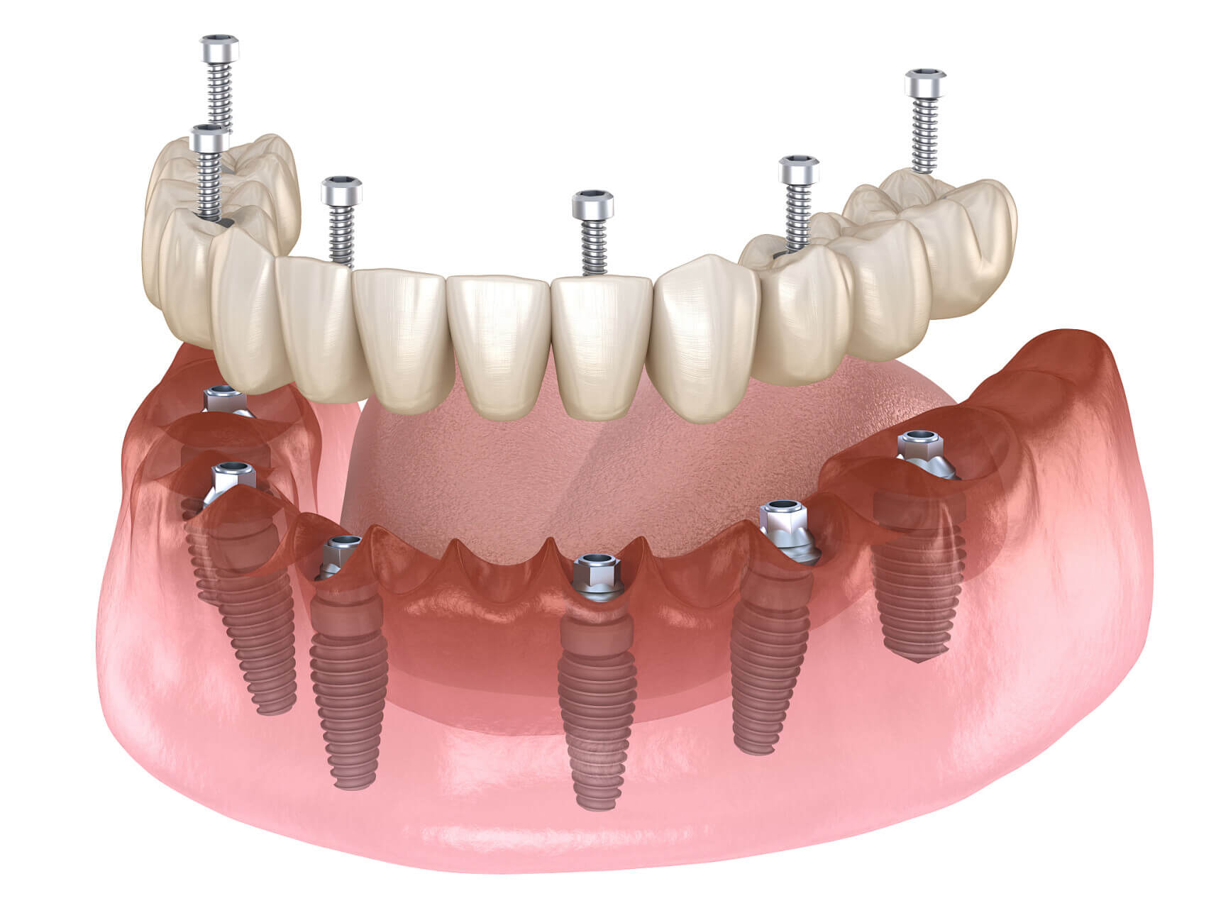 Is it normal for the crown color of a dental implant to differ from the original teeth after undergoing the procedure in Beijing