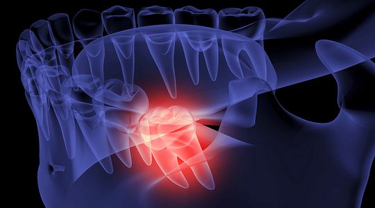 Dental Holidays Packages Australia Affordable Overseas Smile Makeovers