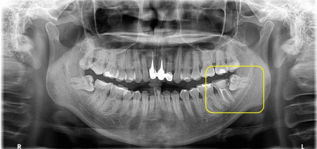 Best Country for Dental Work New Zealand Patients Seeking Quality and Savings