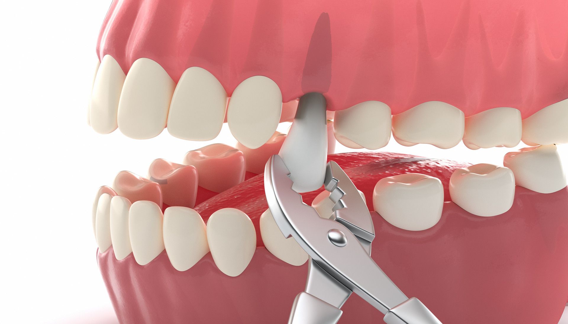 Best Country for Dental Work Aussie Reviews from Overseas Dental Tourists