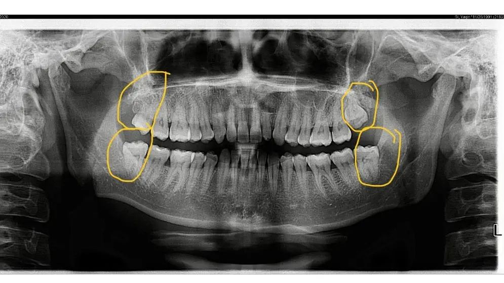 Overseas Dental Packages New Zealand Options for Full Treatment Plans