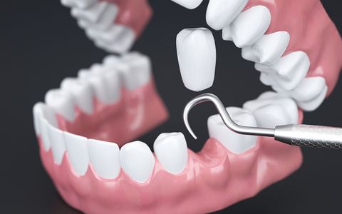 Best Country for Dental Work New Zealand Comparing Thailand, Vietnam, and More