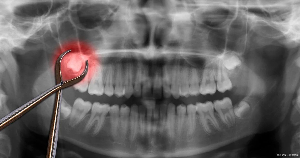 Cheapest Country for Implants for New Zealand Quality vs Price Analysis