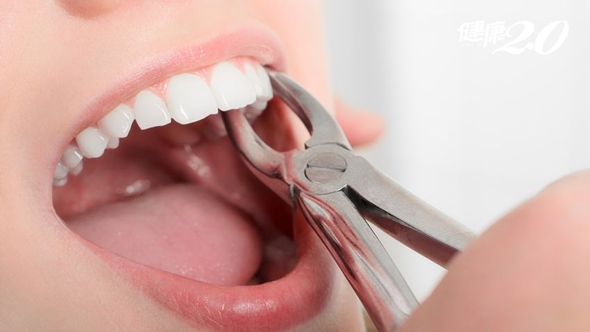 How Long After Dental Filling To Ensure Success in Chinese Mainland