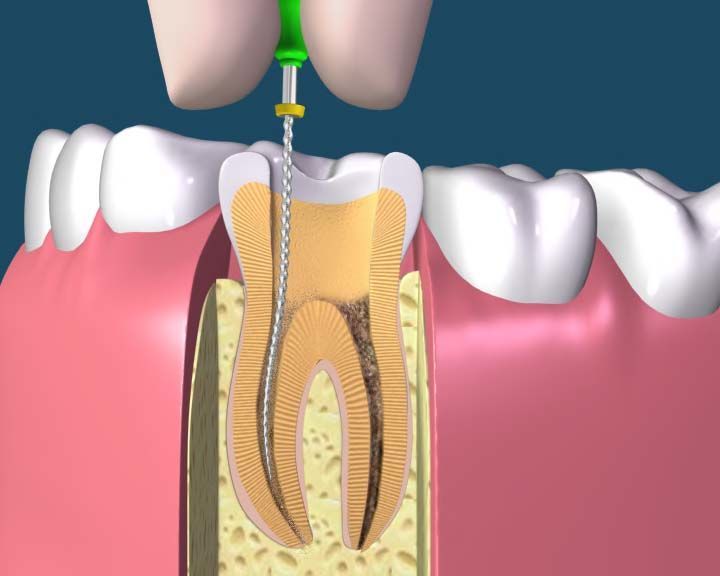 Can Traveling North to Dayaogen Avoid Tooth Extraction