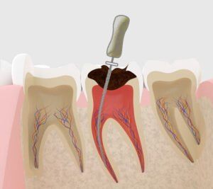 Will root canal treatment in Beijing need to be completed urgently