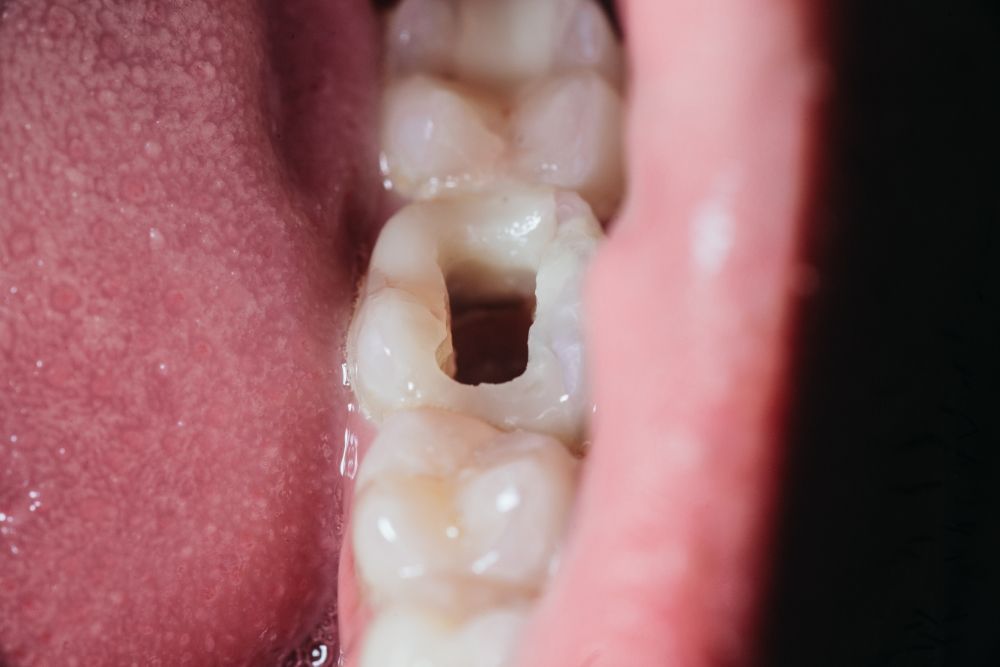 Is it suitable to head north to Duyagen for a first-time root canal treatment