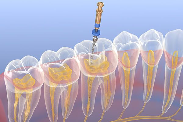 The Northern Journey to Duyen should be suitable for simultaneous cavity treatment.