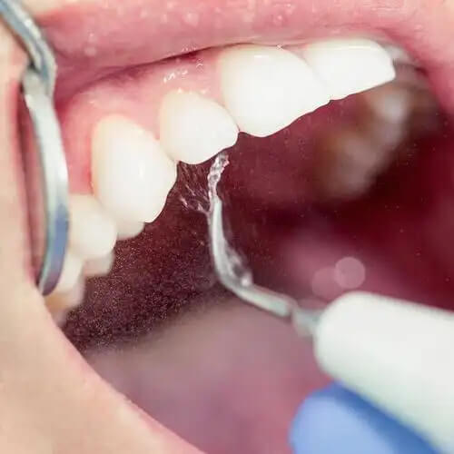 Does the cost of teeth cleaning in Beijing include a dental check-up