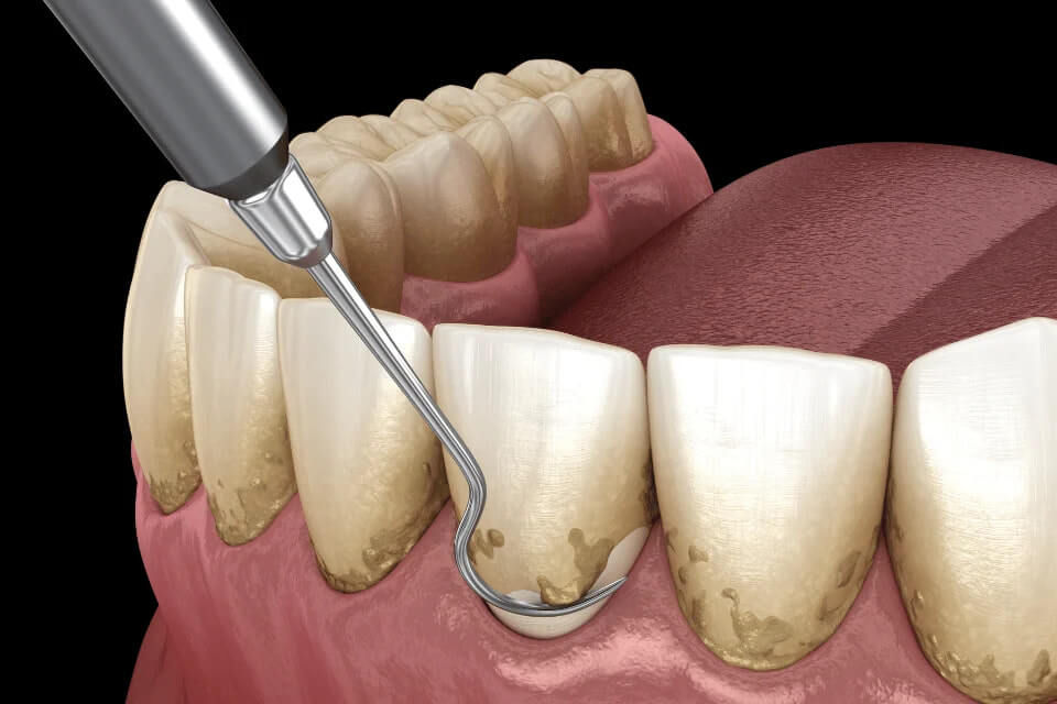 Is It Normal to Have Minor Marks on the Crown After Getting a Dental Implant in Northern Regions